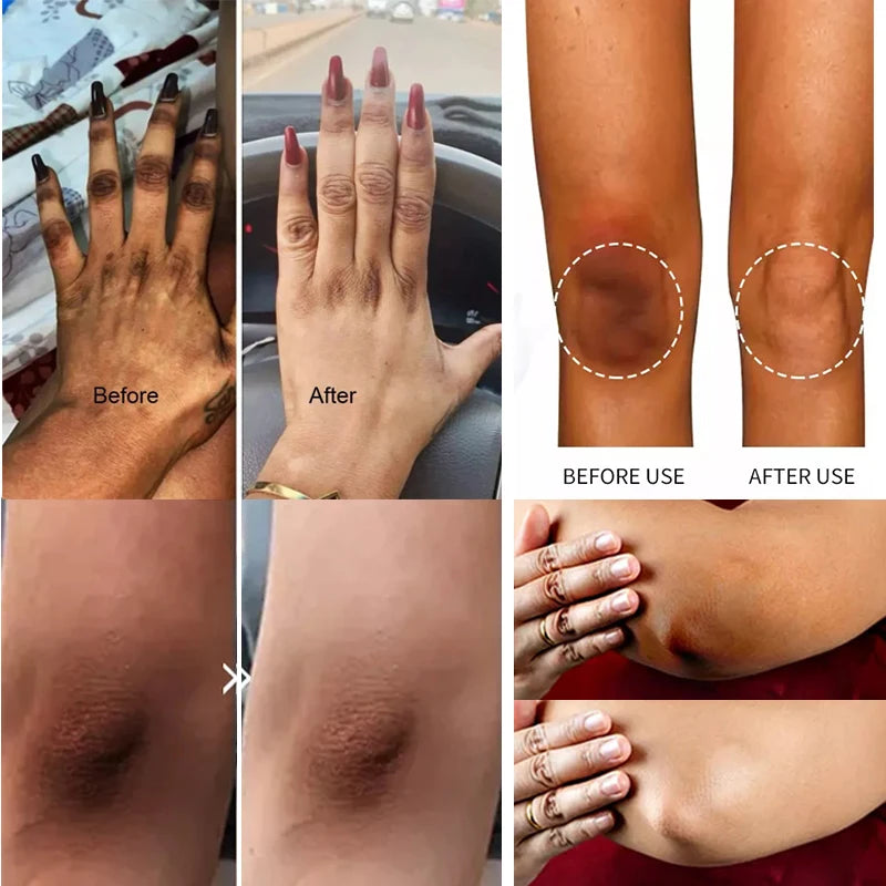 Get Rid Of Dark Knuckles In 7 Days Serum Whitening Knuckle Removal Oil For Cleanser Dark Spots & Elbows Pigmentation Correctors