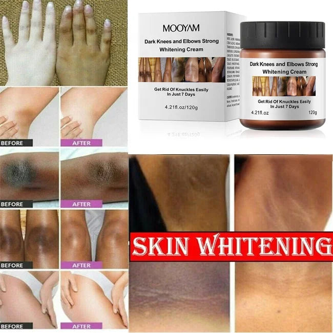 Niacinamide Dark Knees Knuckles Elbows Armpit Whitening Cream,Woman Private Parts Cream for Dark Skin