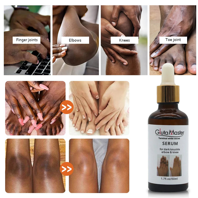 Get Rid Of Dark Knuckles In 7 Days Serum Whitening Knuckle Removal Oil For Cleanser Dark Spots & Elbows Pigmentation Correctors